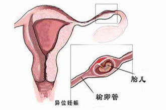 淘宝上香港验血邮寄可靠吗,试管婴儿会发生宫外孕吗？