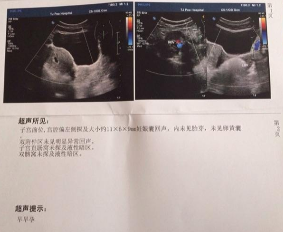 怀孕十四周香港验血,8年不孕，卵巢囊肿孕酮高，等待试管移植的我，竟自然怀